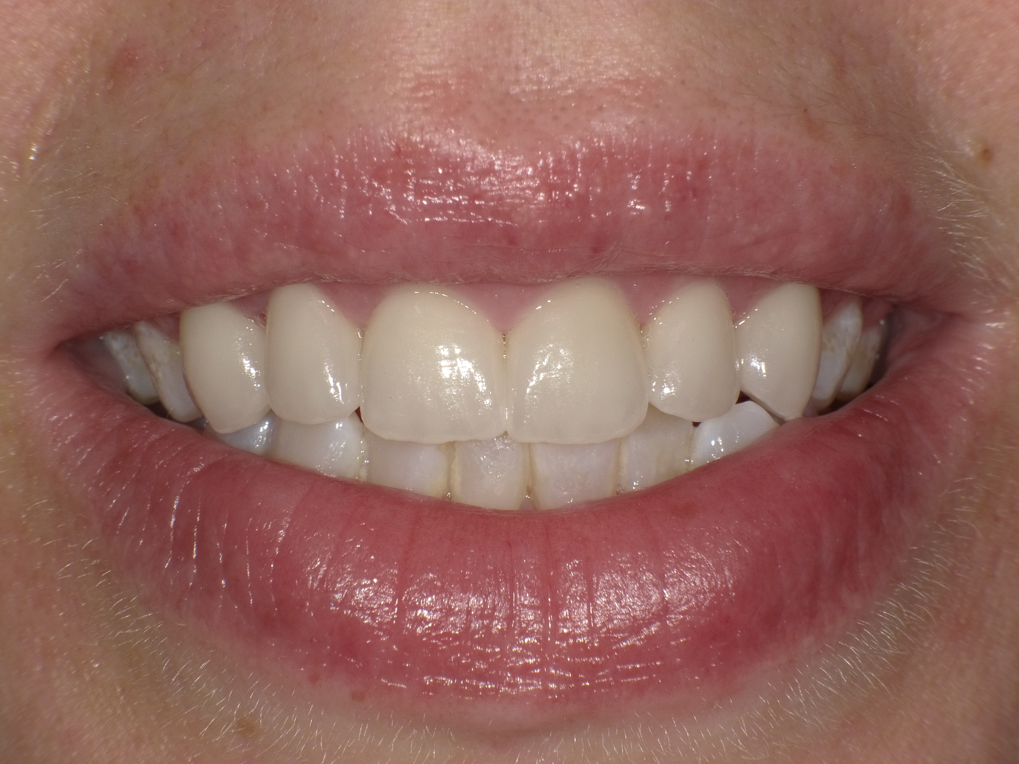 Korrektur der Oberkieferfront durch 6 vollkeramische Veneers in nur 2 Terminen